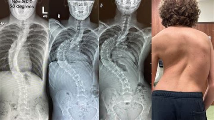 Can a heavy backpack cause scoliosis?